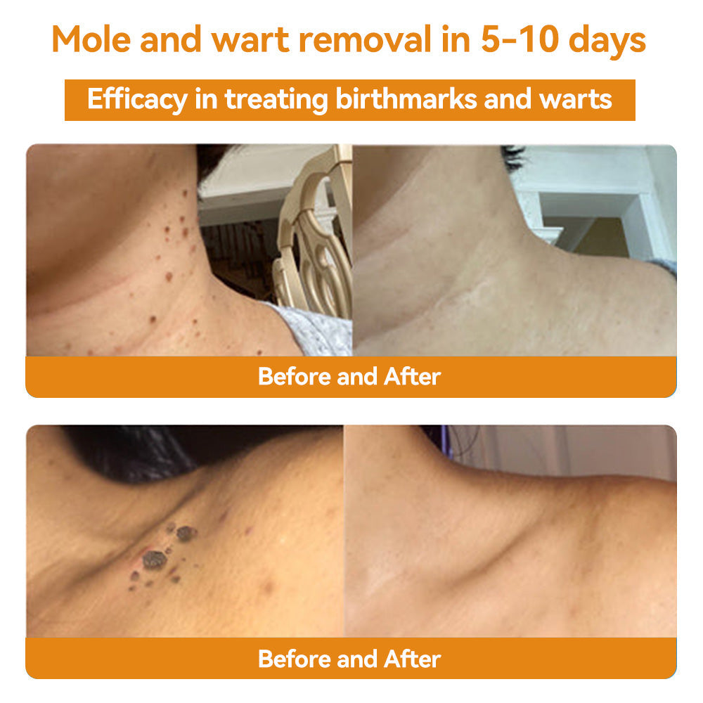 Bee Venom Skin Treatment Cream Royal Pharmaceutical Society (RPS) Approved(Helping with acne, wart, rosacea, psoriasis, age spots, eczema, and reducing the appearance of stretch marks) 🌳