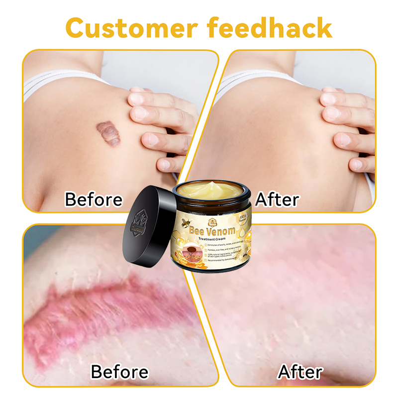 Bee Venom Skin Treatment Cream Royal Pharmaceutical Society (RPS) Approved(Helping with acne, wart, rosacea, psoriasis, age spots, eczema, and reducing the appearance of stretch marks) 🌳