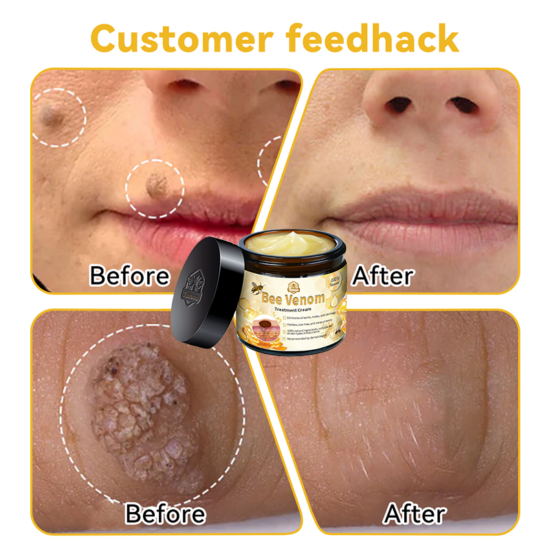 Bee Venom Skin Treatment Cream Royal Pharmaceutical Society (RPS) Approved(Helping with acne, wart, rosacea, psoriasis, age spots, eczema, and reducing the appearance of stretch marks) 🌳
